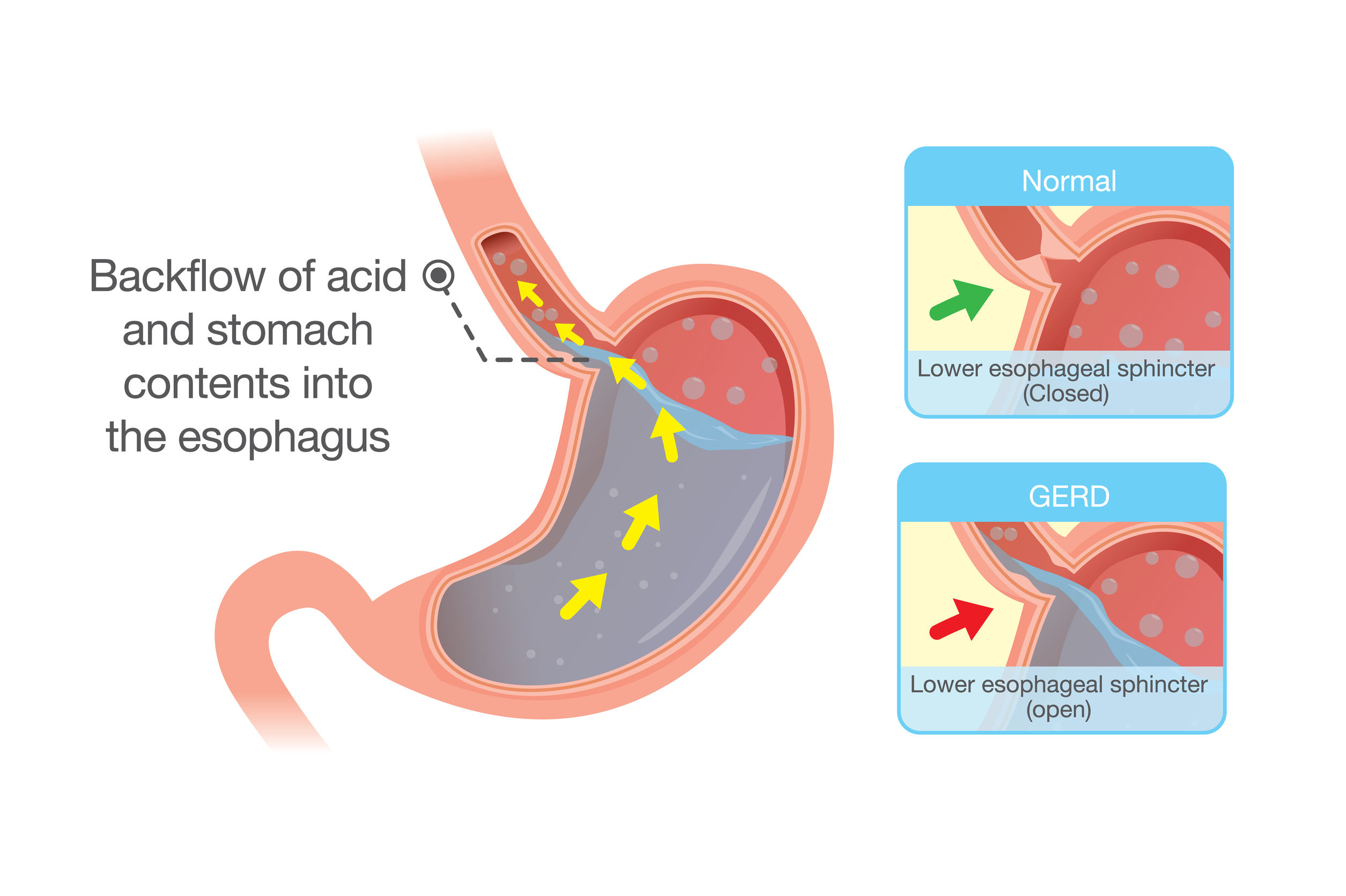 gastroesophageal-reflux-disease-gerd-harvard-health